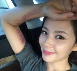 明星身上的疤,揭秘明星们的伤痕故事